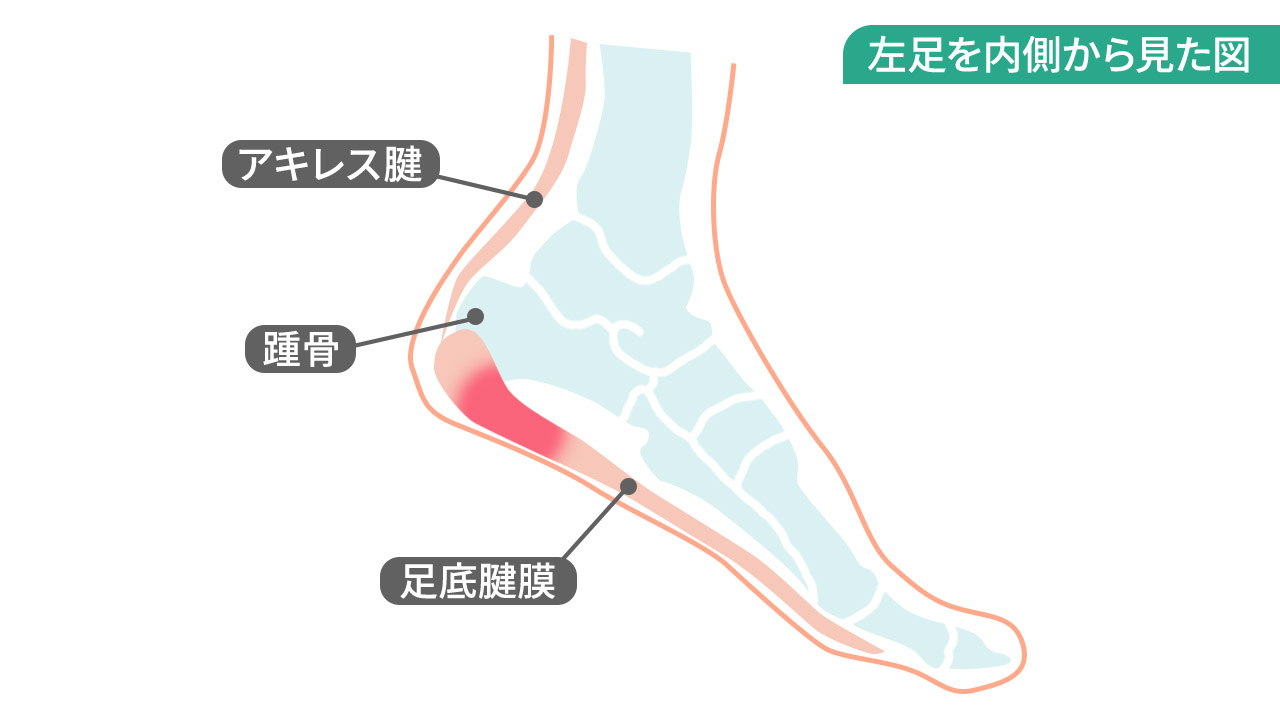 ランニングにケガはつきもの 足の裏 かかと 膝の痛みやシンスプリントの原因と予防法 ランニングにケガはつきもの 足の裏 かかと 膝の痛みやシンスプリントの原因と予防法