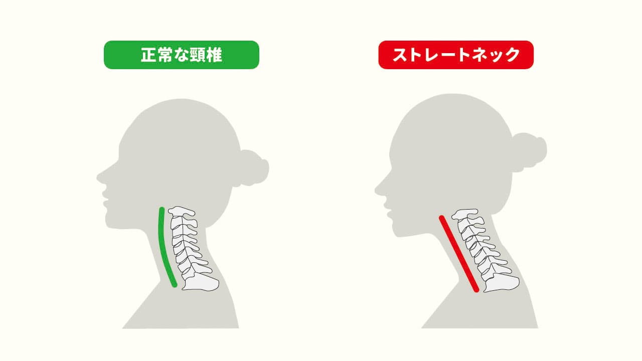 さまざまな症状を引き起こすストレートネックとは？原因と予防方法を紹介